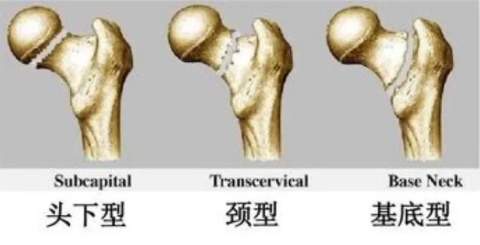 股骨颈骨折莫大意，也许离“坏死”不远了！插图1