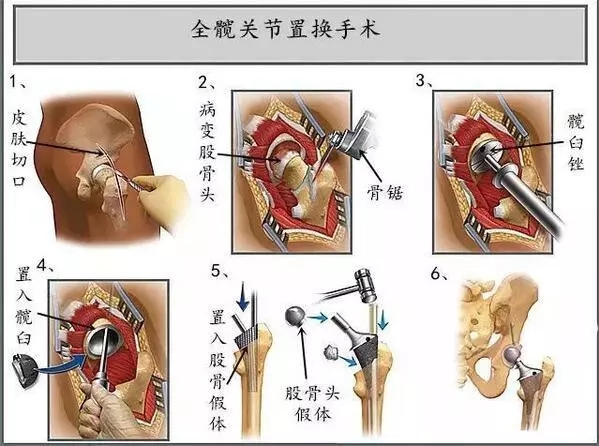 悔！早点知道这些，就不会选择股骨头置换了插图